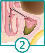 Balloon-Sinuplasty-Step2